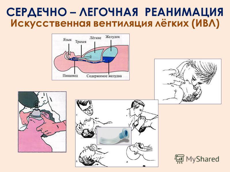 Искусственное дыхание при сердечно легочной реанимации