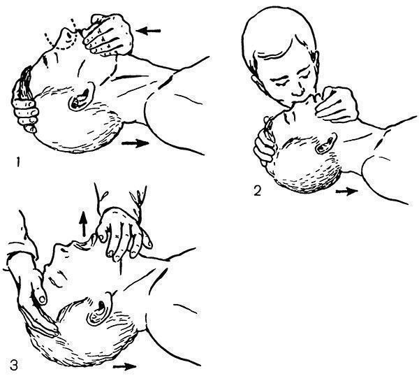 Изо рта в нос. Искусственное дыхание изо рта в нос. Искусственная вентиляция легких методом рот в рот. Искусственная вентиляция лёгких алгоритм. ИВЛ искусственная вентиляция легких.