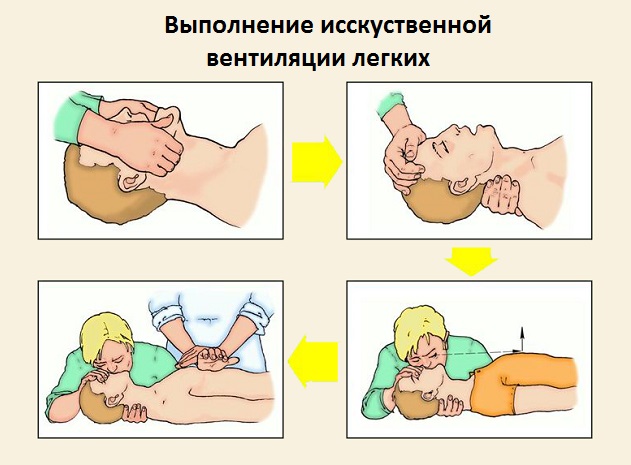 Искусственная вентиляция легких картинки